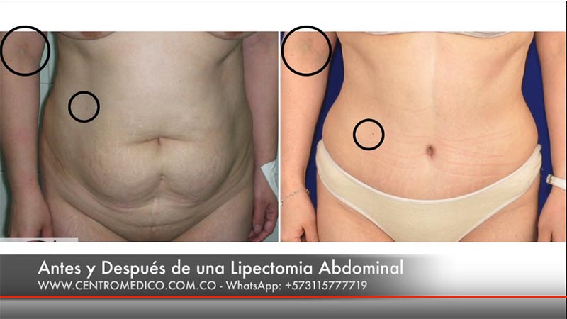 lipectomia-abdominal antes y despues