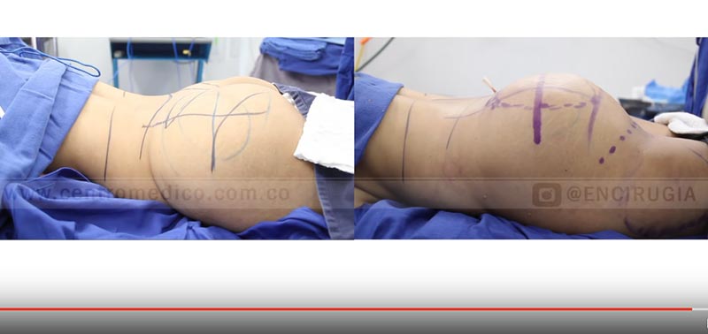 cirugia de gluteos antes y despues