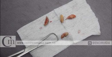 retiro de biopolimeros en mexico