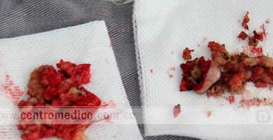 retiro de biopolimeros en españa