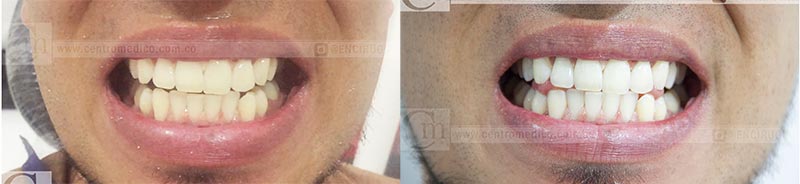 blanqueamiento dental pereira